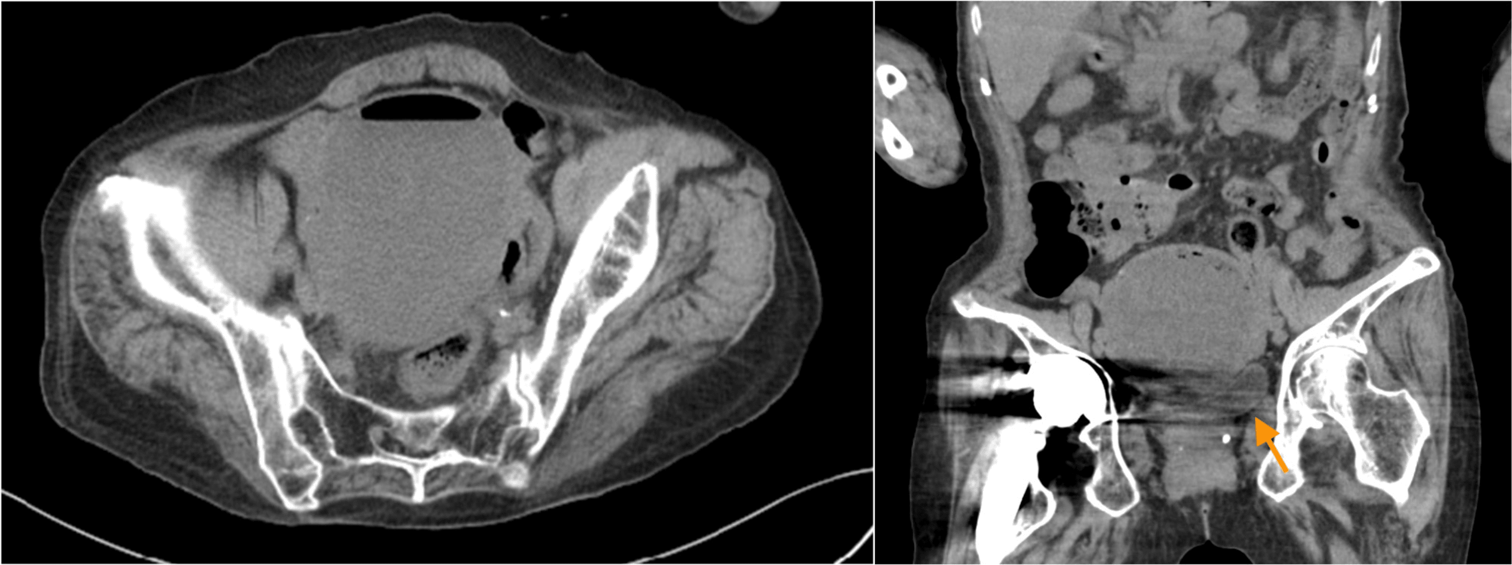 Cureus | A Case of Pyometra Caused by Achromobacter xylosoxidans and γ ...