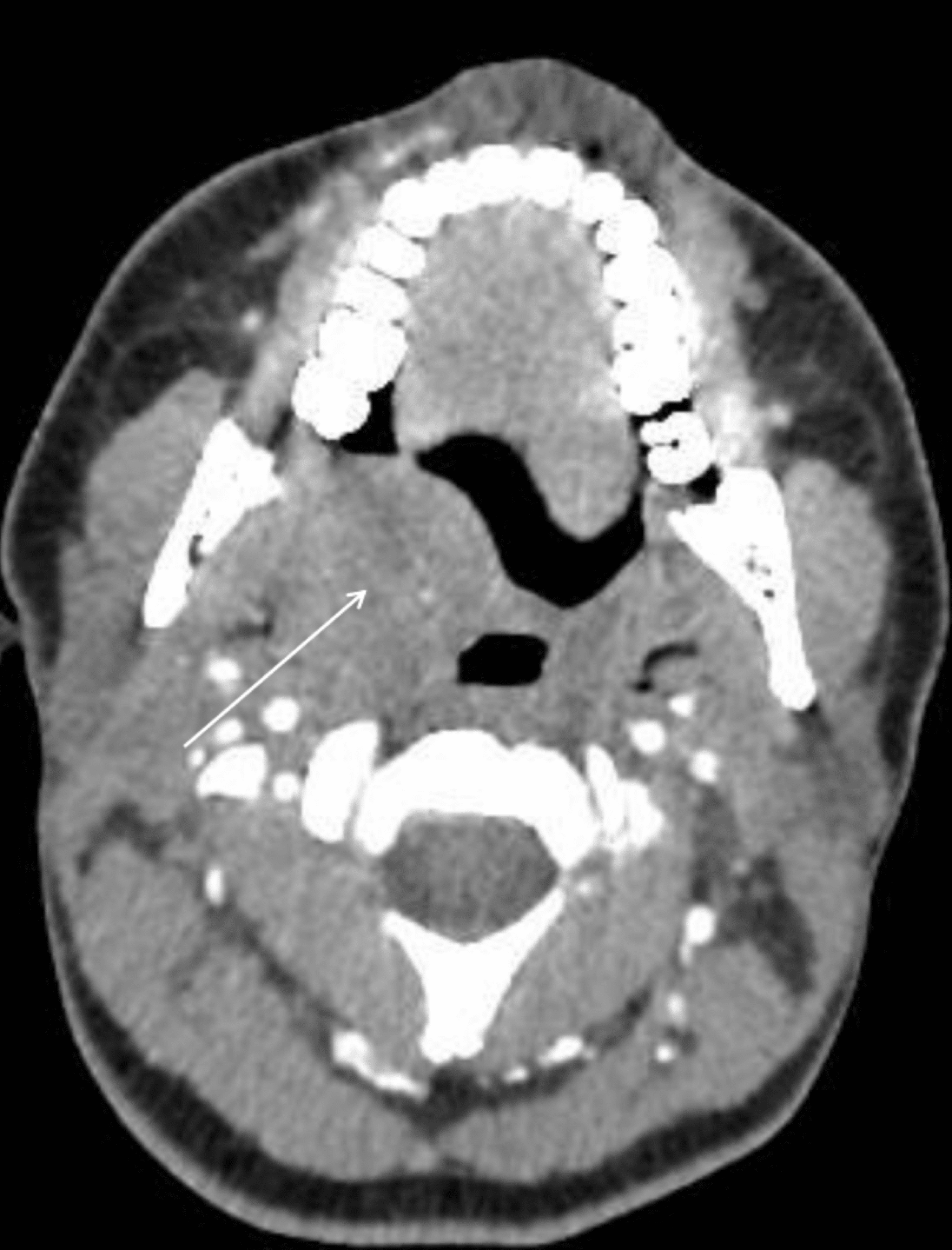 Cureus A Giant Nodule of the Soft Palate Mimicking a Tumor A Case of
