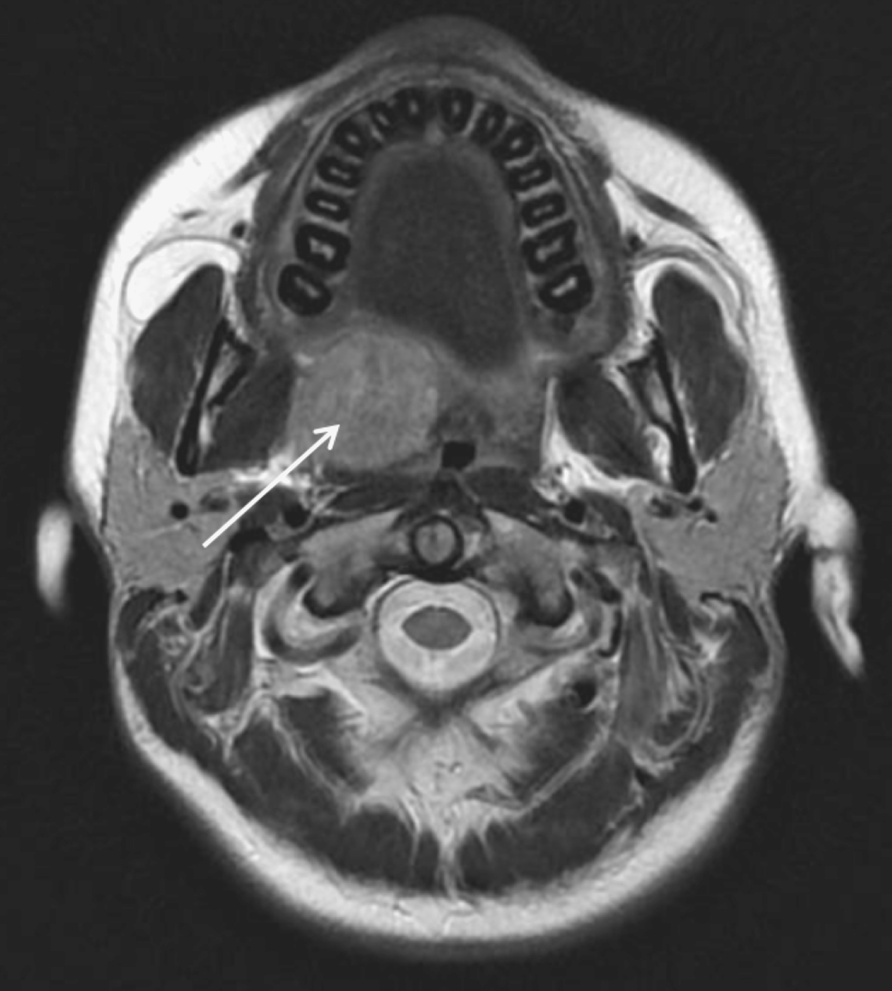 Cureus | A Giant Nodule of the Soft Palate Mimicking a Tumor: A Case of ...