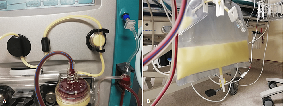 Filtered-plasma-(A)-in-the-extracorporeal-circuit-and-(B)-in-the-effluent-bag-during-plasmapheresis.