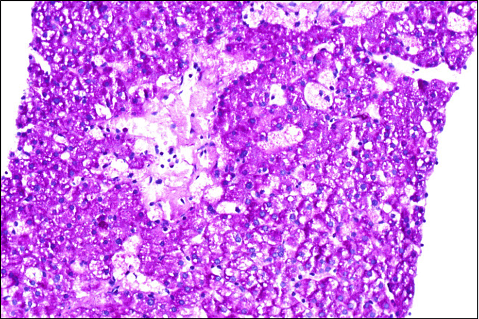 Cureus NiemannPick Disease A Case Report and Literature Review