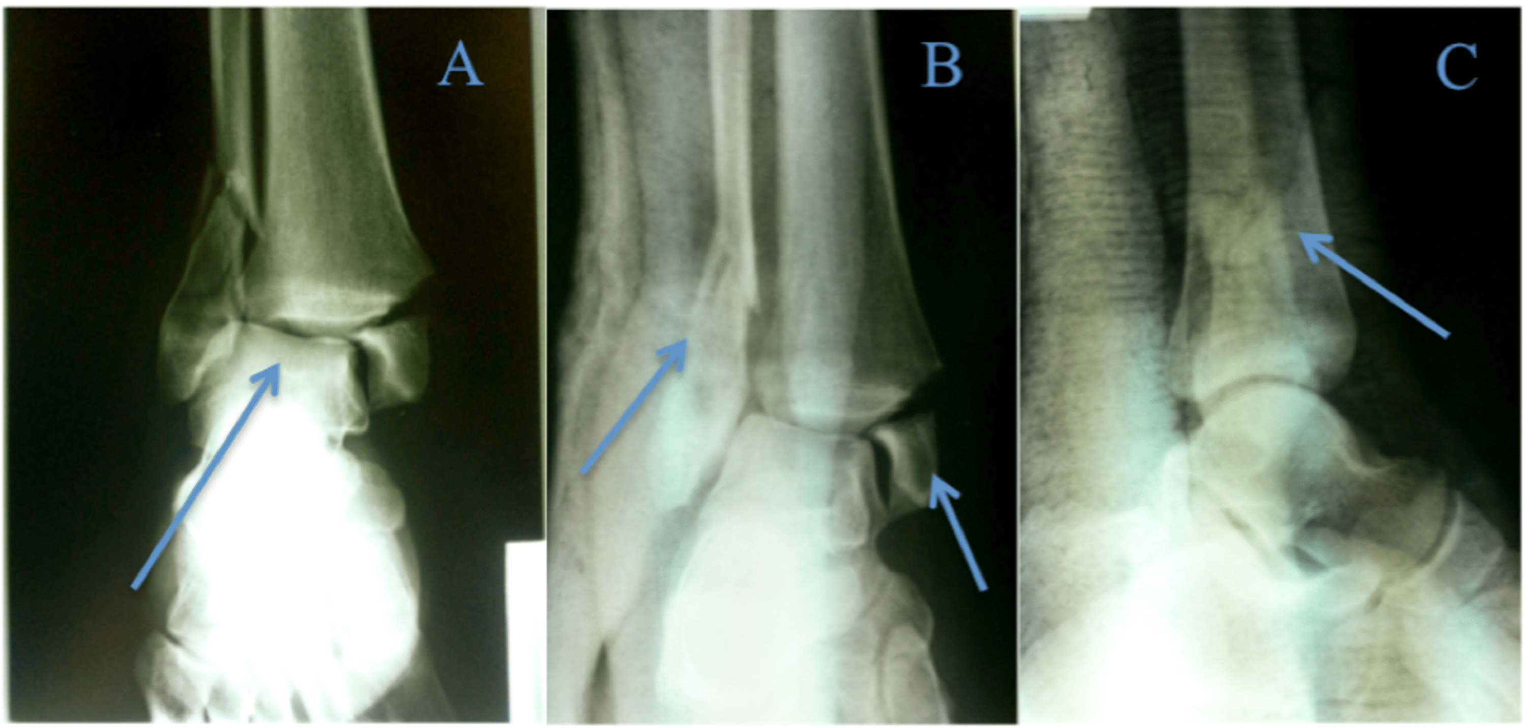 Cureus | Rupture Of The Tibialis Posterior Tendon With Associated ...