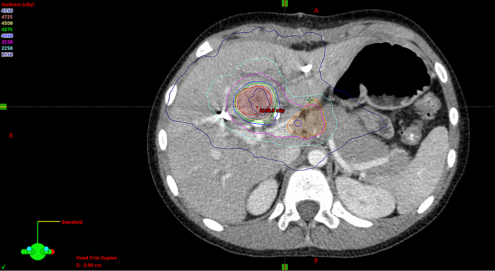 Stereotactic-body-radiotherapy-treatment-plan-for-central-hepatocellular-carcinoma-with-nodal-involvement