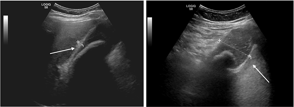 gallstones ultrasound removal