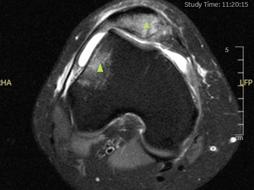 Cureus, Patterns of Associated Knee Ligament and Chondral Injuries in  First-Time Traumatic Patellar Dislocation: A Retrospective Magnetic  Resonance Imaging (MRI) -Based Study
