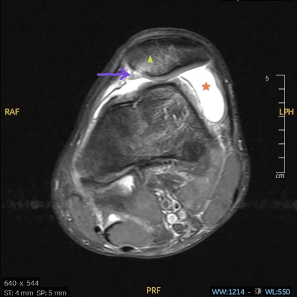 Patterns Of Associated Knee Ligament And Chondral Injuries In First