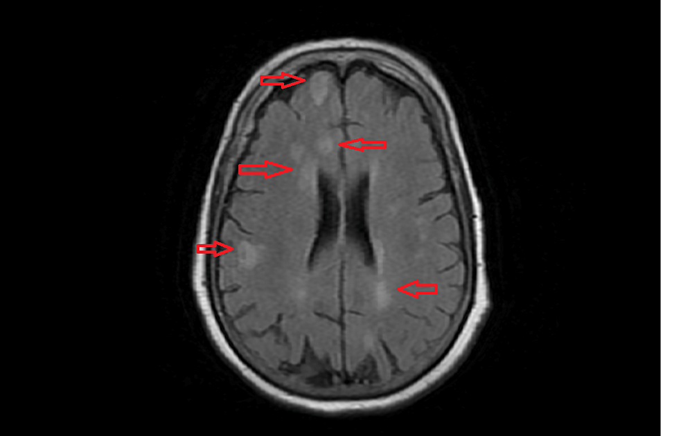 Fatal Acute Disseminated Encephalomyelitis Post-COVID-19 Vaccination: A Rare Case Report Fatal Acute Disseminated Encephalomyelitis Post-COVID-19 Vaccination: A Rare Case Report