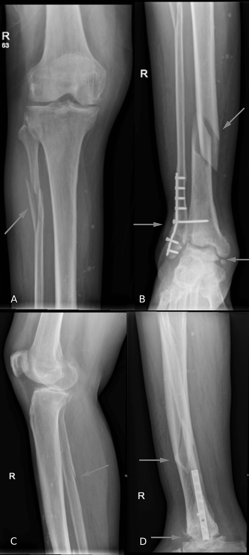 (A,-B)-Anteroposterior-and-(C,-D)-lateral-X-rays-of-the-right-tibia-and-fibula-after-the-injury-