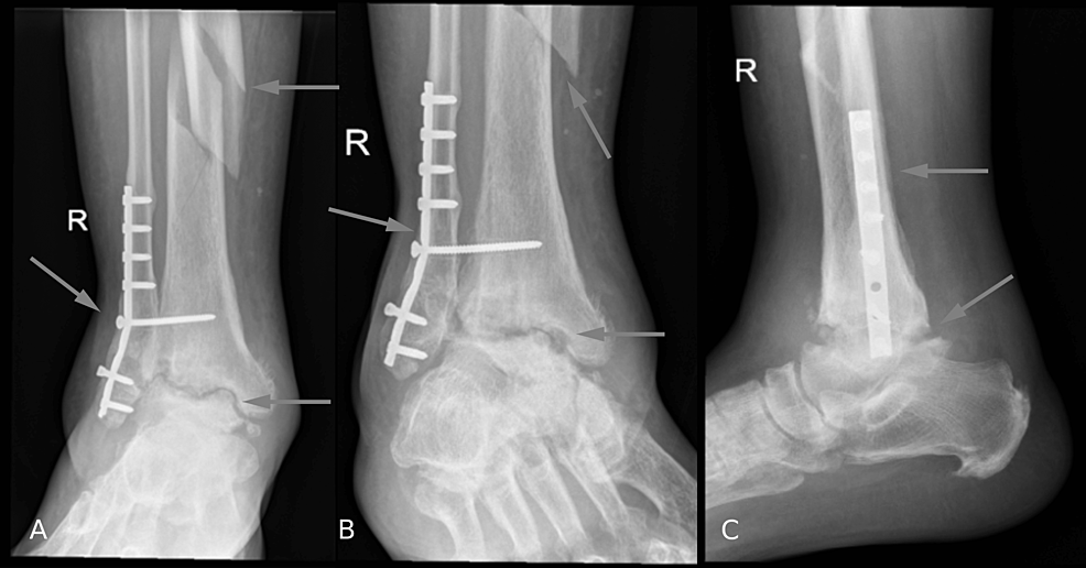 (A)-Anteroposterior,-(B)-oblique,-and-(C)-lateral-X-rays-of-the-ankle-joint-after-the-injury