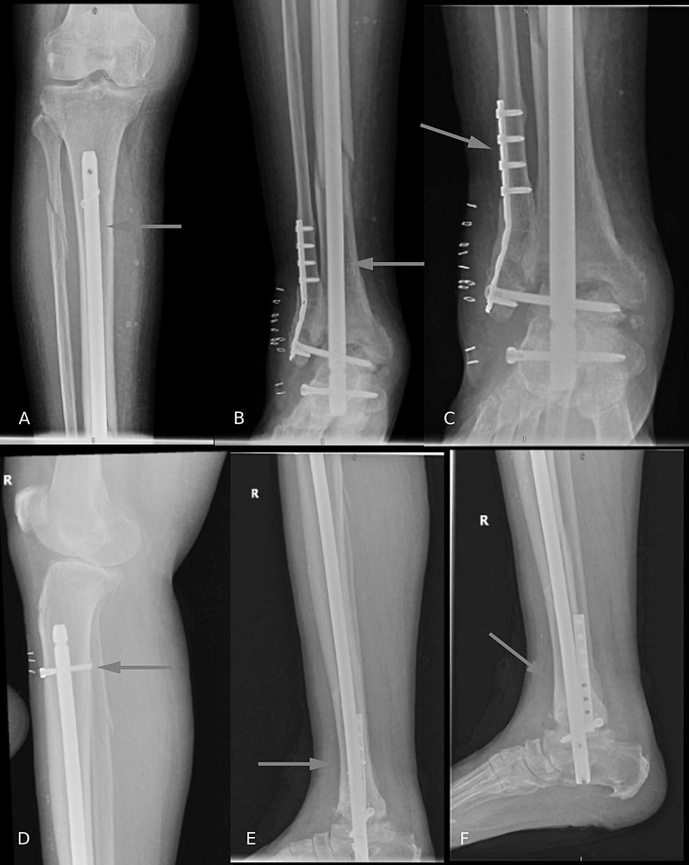 X-rays-after-the-surgery.-(A,-B)-Anteroposterior-view-of-the-right-tibia-and-fibula,-(C)-anteroposterior-X-ray-of-the-ankle-joint,-(D,-E)-lateral-views-of-the-leg,-(F)-lateral-view-of-the-ankle
