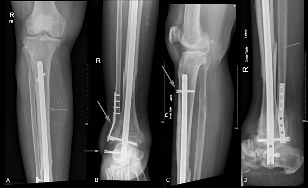 (A,-B)-Anteroposterior-and-(C,-D)-lateral-X-rays-of-the-right-tibia-and-fibula-on-the-latest-follow-up