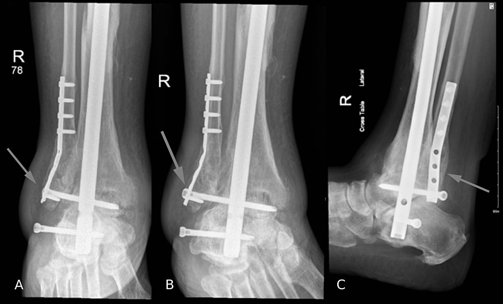(A)-Anteroposterior,-(B)-oblique,-and-(C)-lateral-X-rays-of-the-right-ankle-joint-on-the-latest-follow-up
