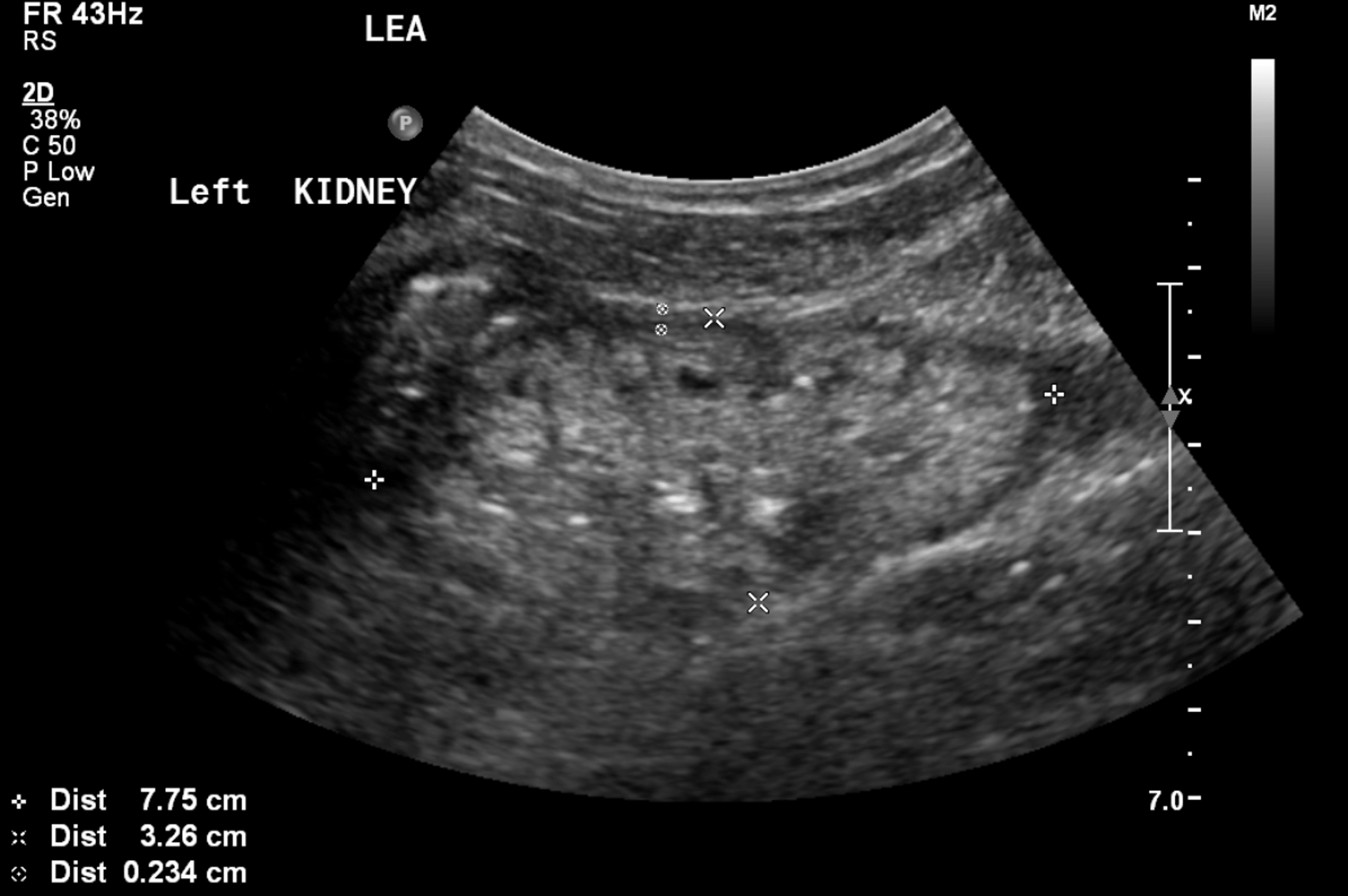 Cureus COQ8BRelated SteroidResistant Nephrotic Syndrome in Saudi