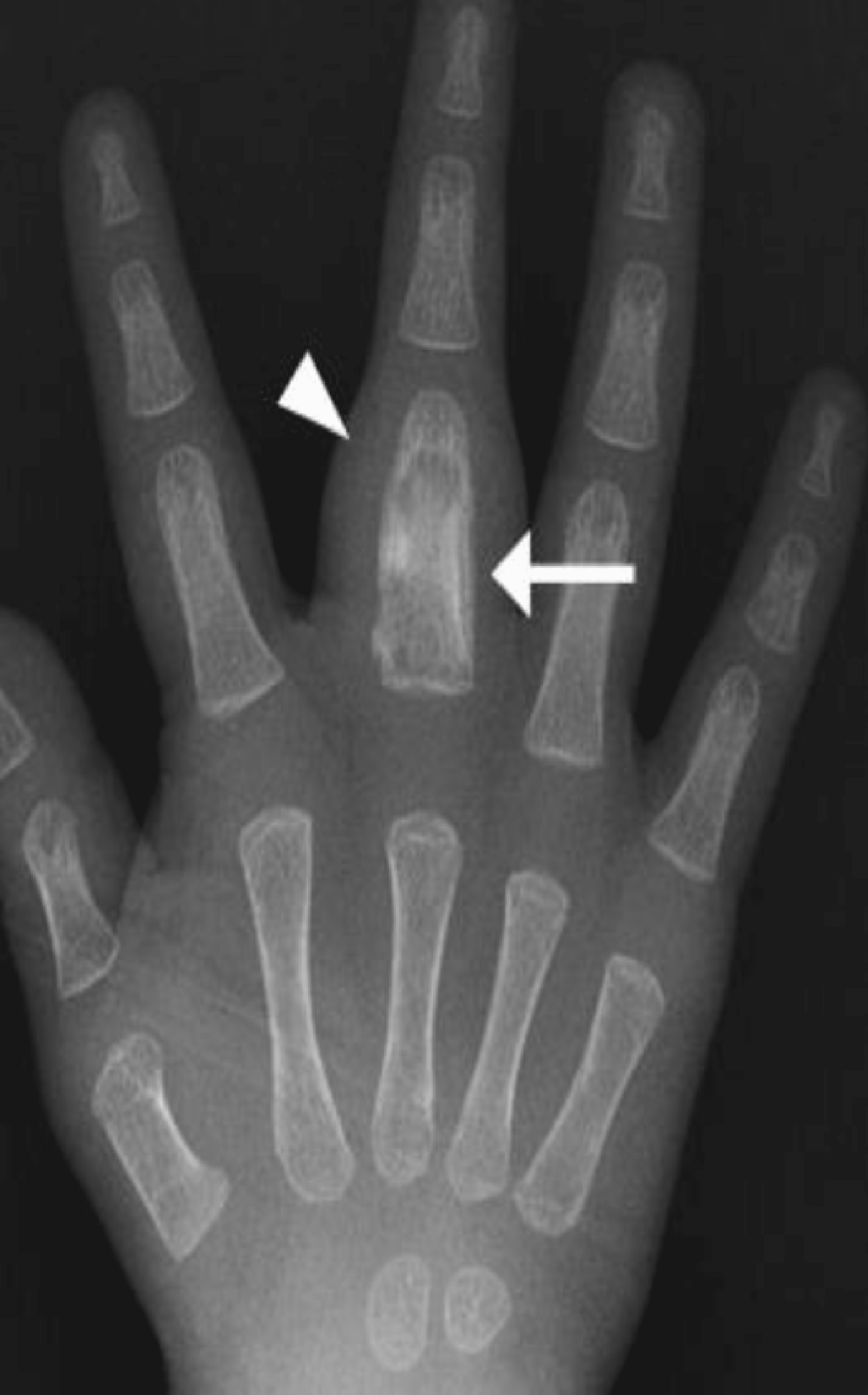 cureus-bacillus-calmette-gu-rin-vaccine-related-osteomyelitis-in