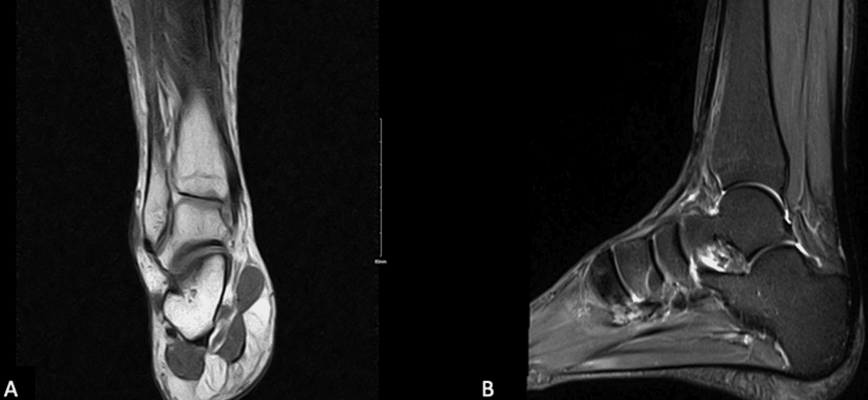 Hovedkvarter sortere Sund og rask Cureus | Approach to Ankle Instability in Patients With a Negative Ankle MRI:  A Case Series | Article