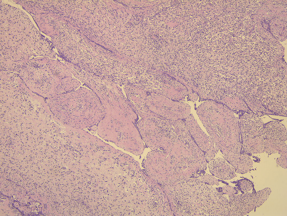 Histopathology-of-the-excised-breast-mass;-biphasic-area. 