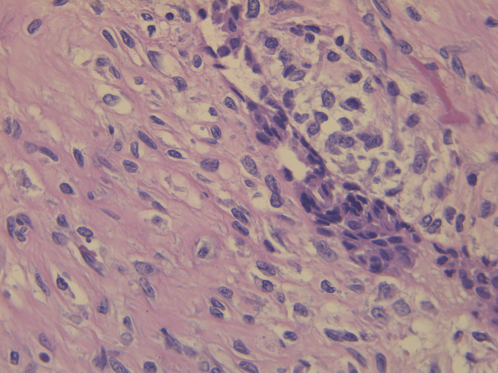 Histopathology-of-the-excised-breast-mass;-close-up.
