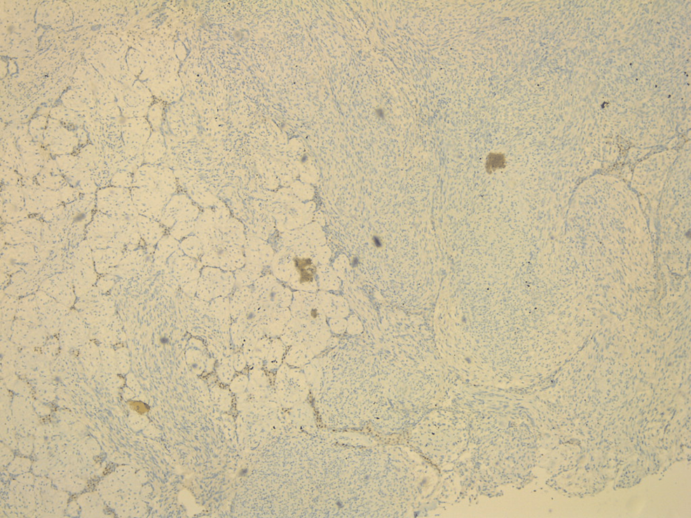 Histopathology-of-the-excised-breast-mass. 