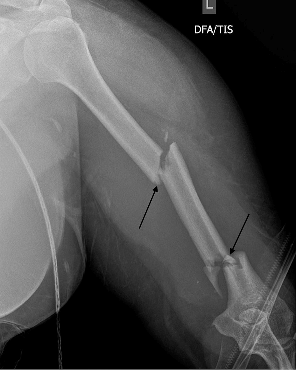 A postoperative radiograph of the femur. Retrograde intramedullary... |  Download Scientific Diagram