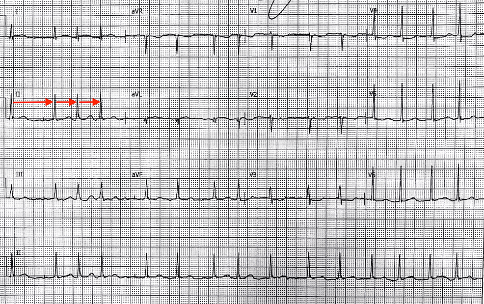 Cureus Transient Atrial Fibrillation After Epinephrine Use for