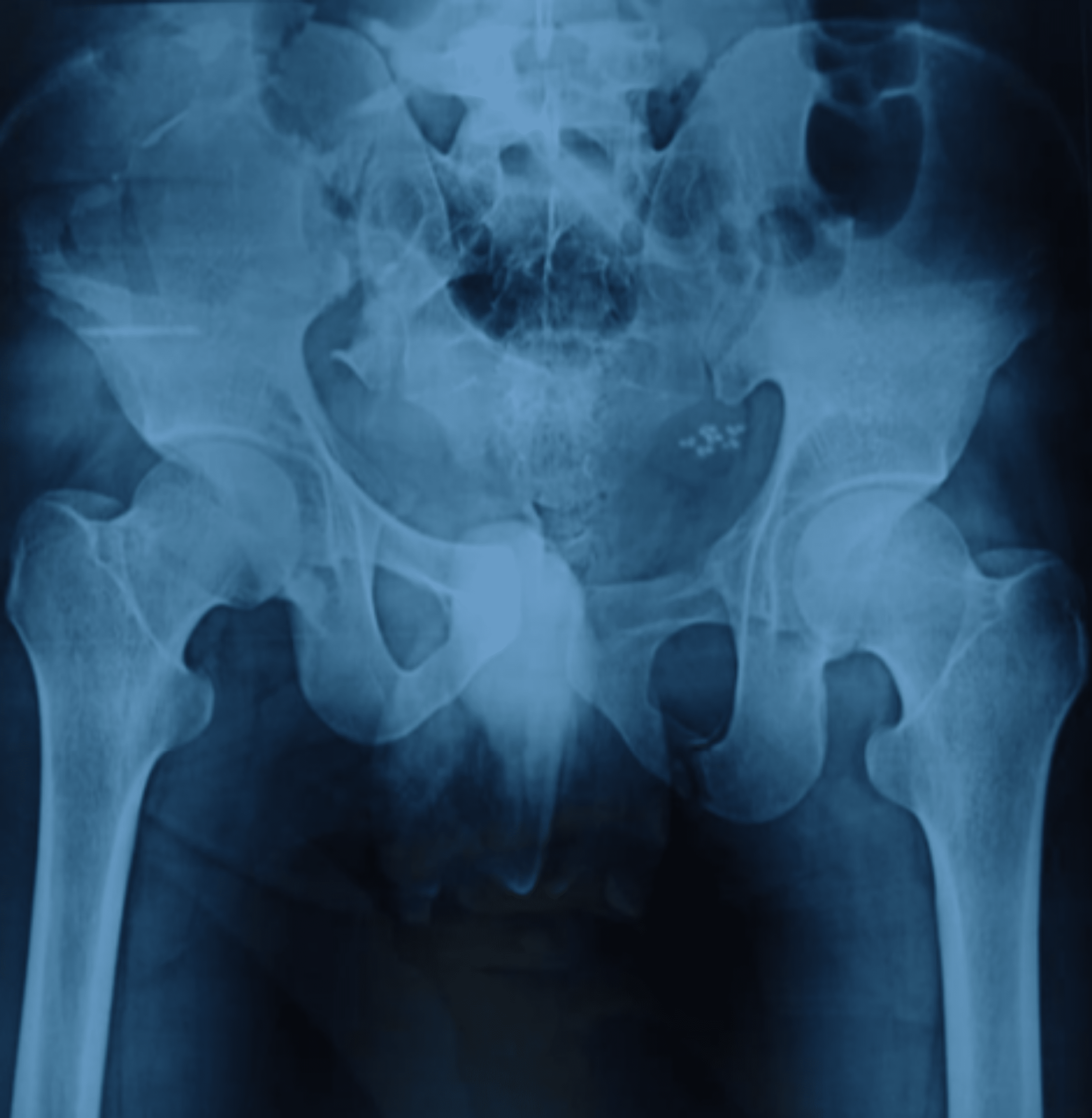 Cureus | Crescent Fracture of the Pelvis: A Case Report