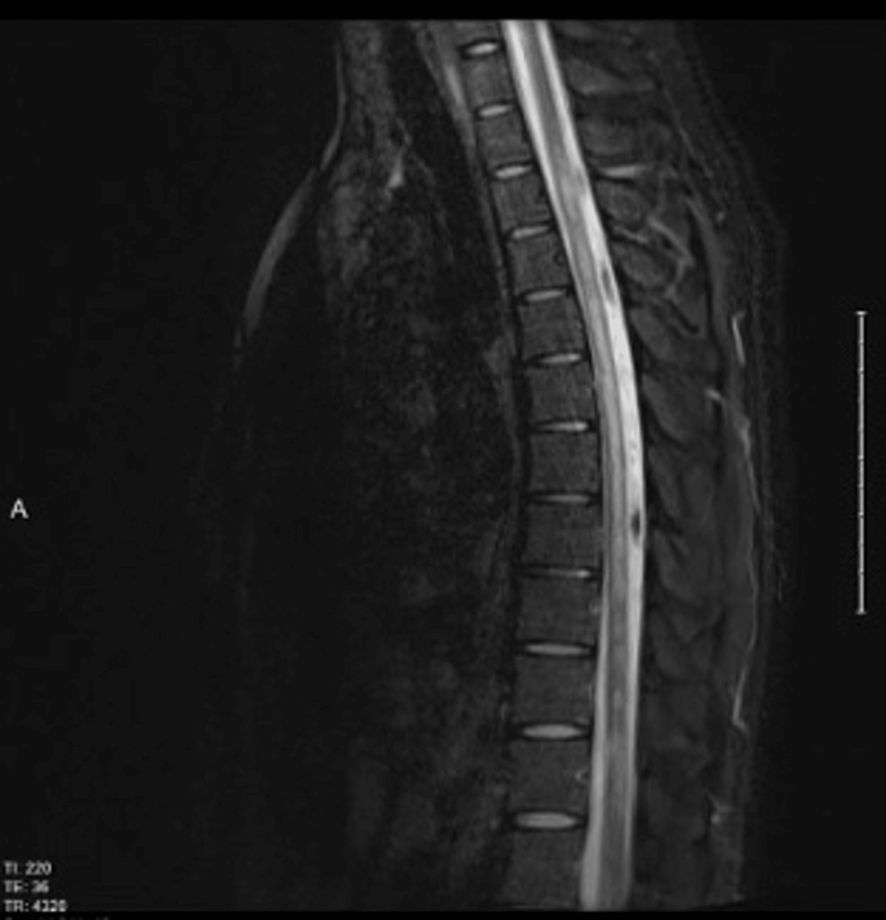 Cureus Combined Central and Peripheral Demyelination in a Patient of