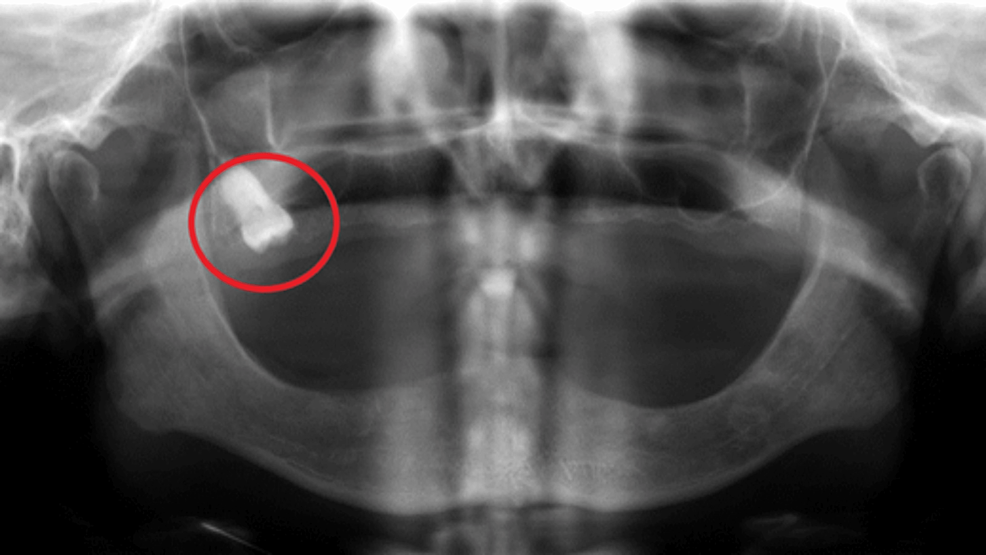 Cureus Prevalence Of Total Edentulism And Panoramic Radiographic Findings Of Totally