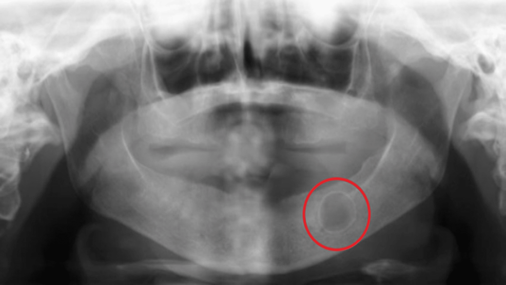 Cureus Prevalence of Total Edentulism and Panoramic Radiographic