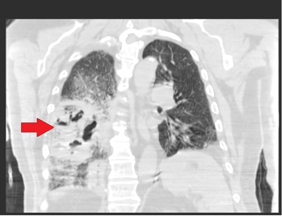 CT-chest-coronal-view-showing-right-lower-lobe-cavitary-lesion.