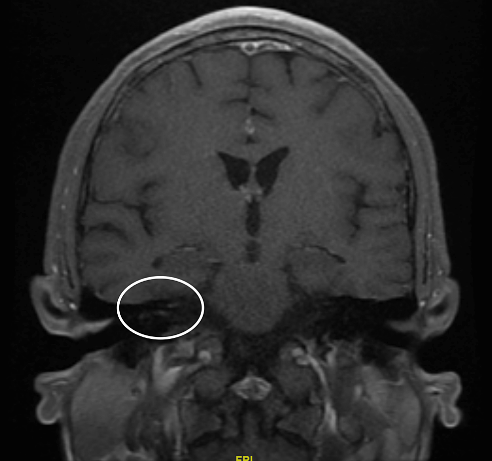 cureus-acute-hiv-presenting-with-unilateral-facial-nerve-paralysis-a