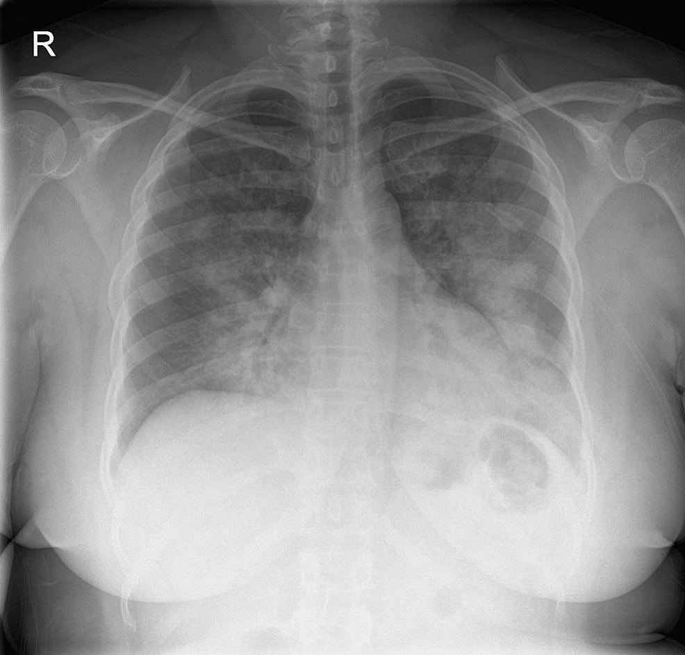 pulmonary-edema-causes-symptoms-diagnosis-treatment