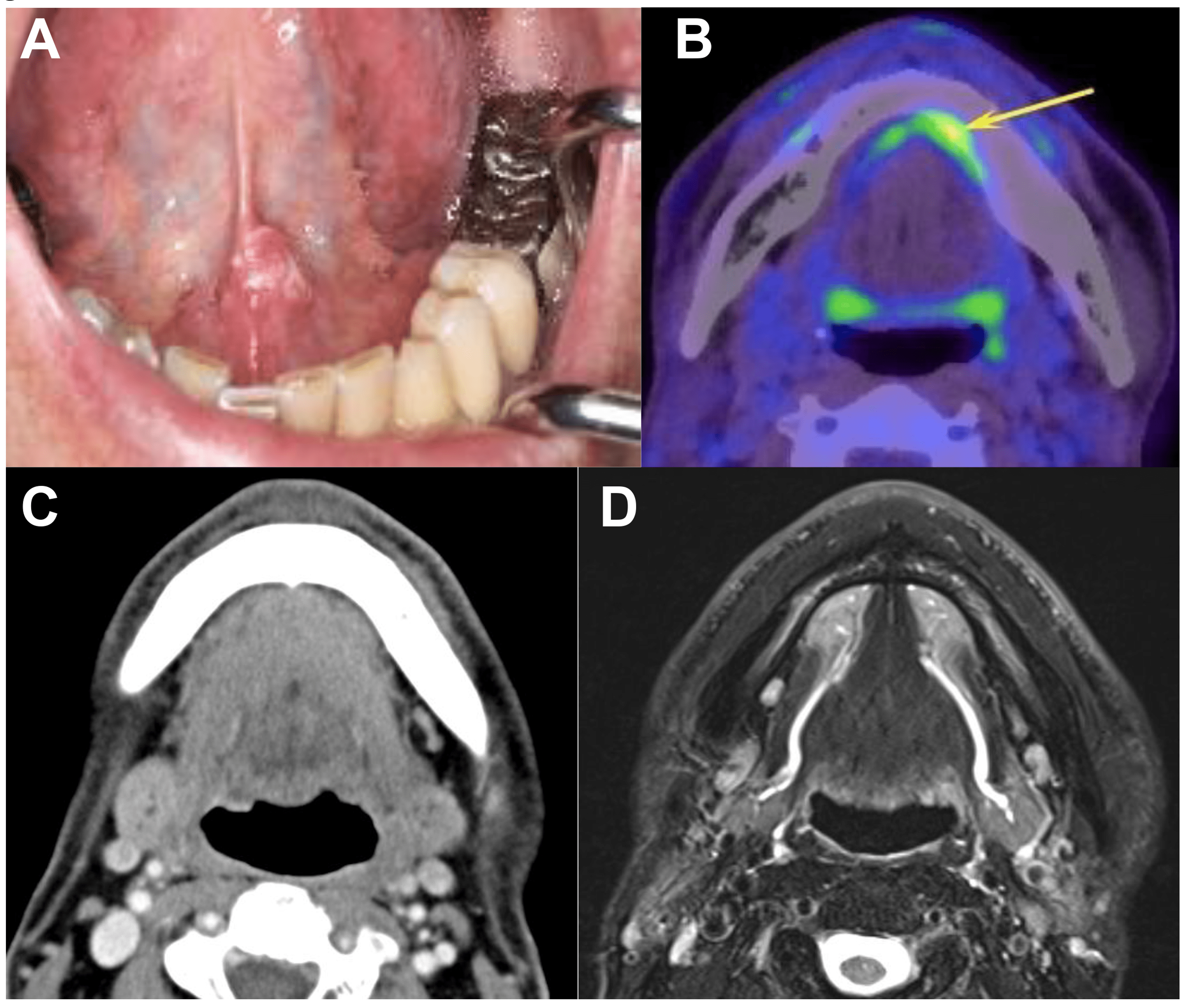 Retrograde Migration of an Au198 Grain to the Submandibular Gland Post Brachytherapy Treatment