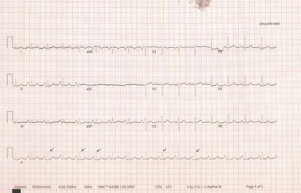 Cureus | Subacute Cardiac Tamponade With Massive Pericardial Effusion |  Article