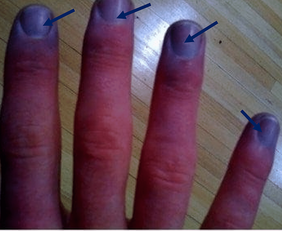 Here's Why You Should See a Doctor If You Notice Black On Your Nail