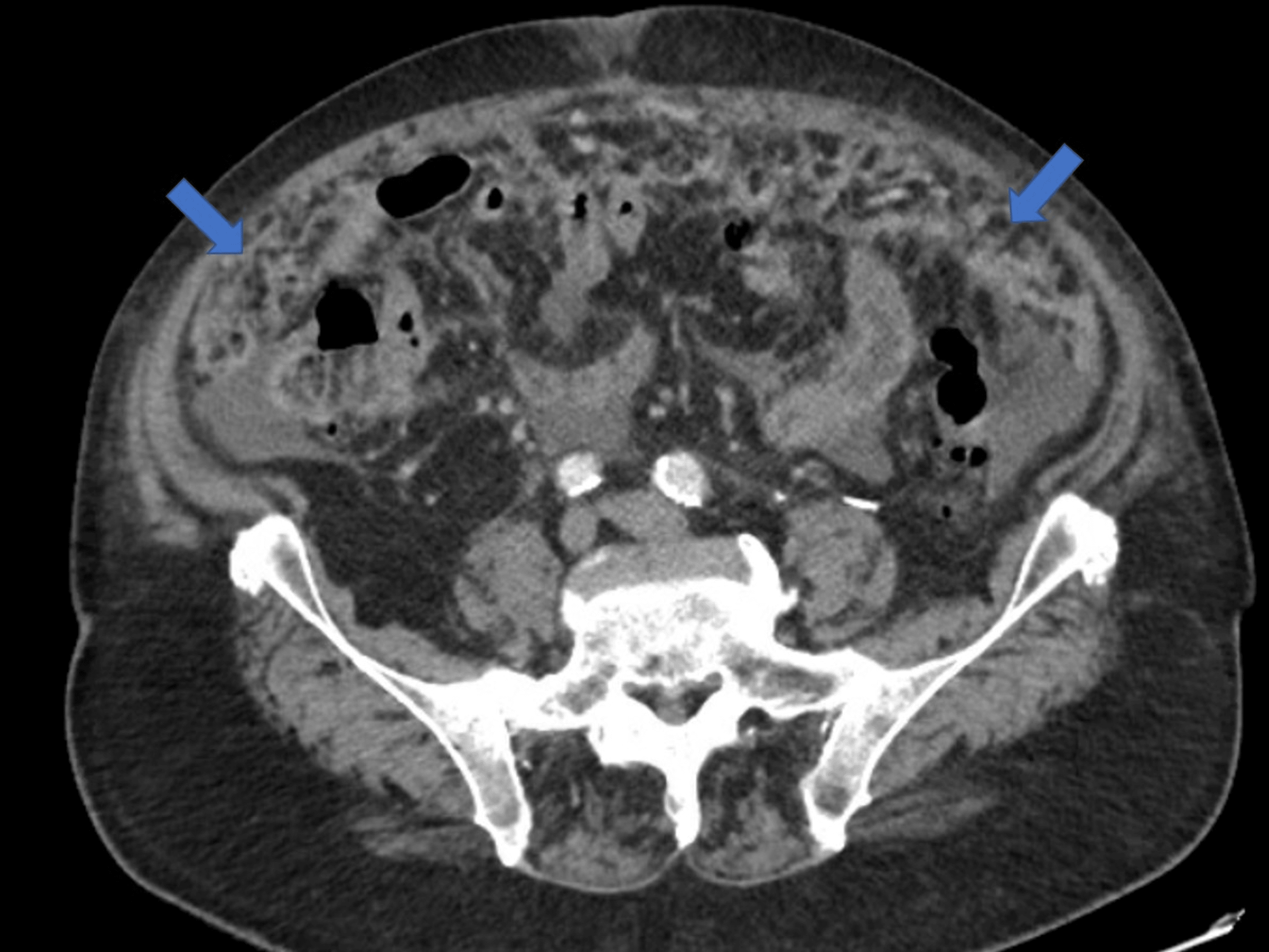 Peritoneal Carcinomatosis From Malignant Melanoma After Wide Local