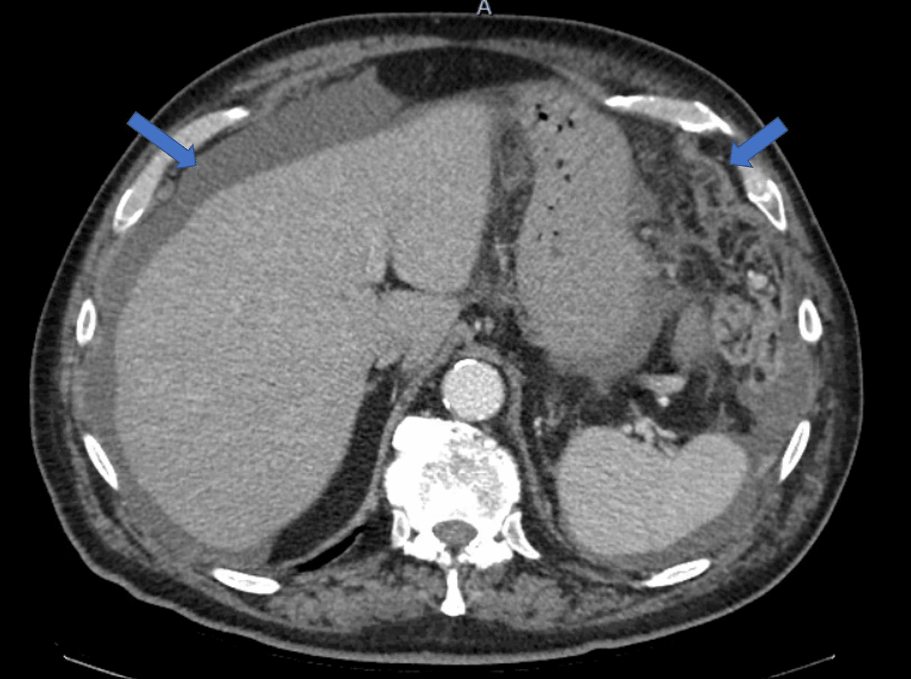 Peritoneal Carcinomatosis From Malignant Melanoma After Wide Local