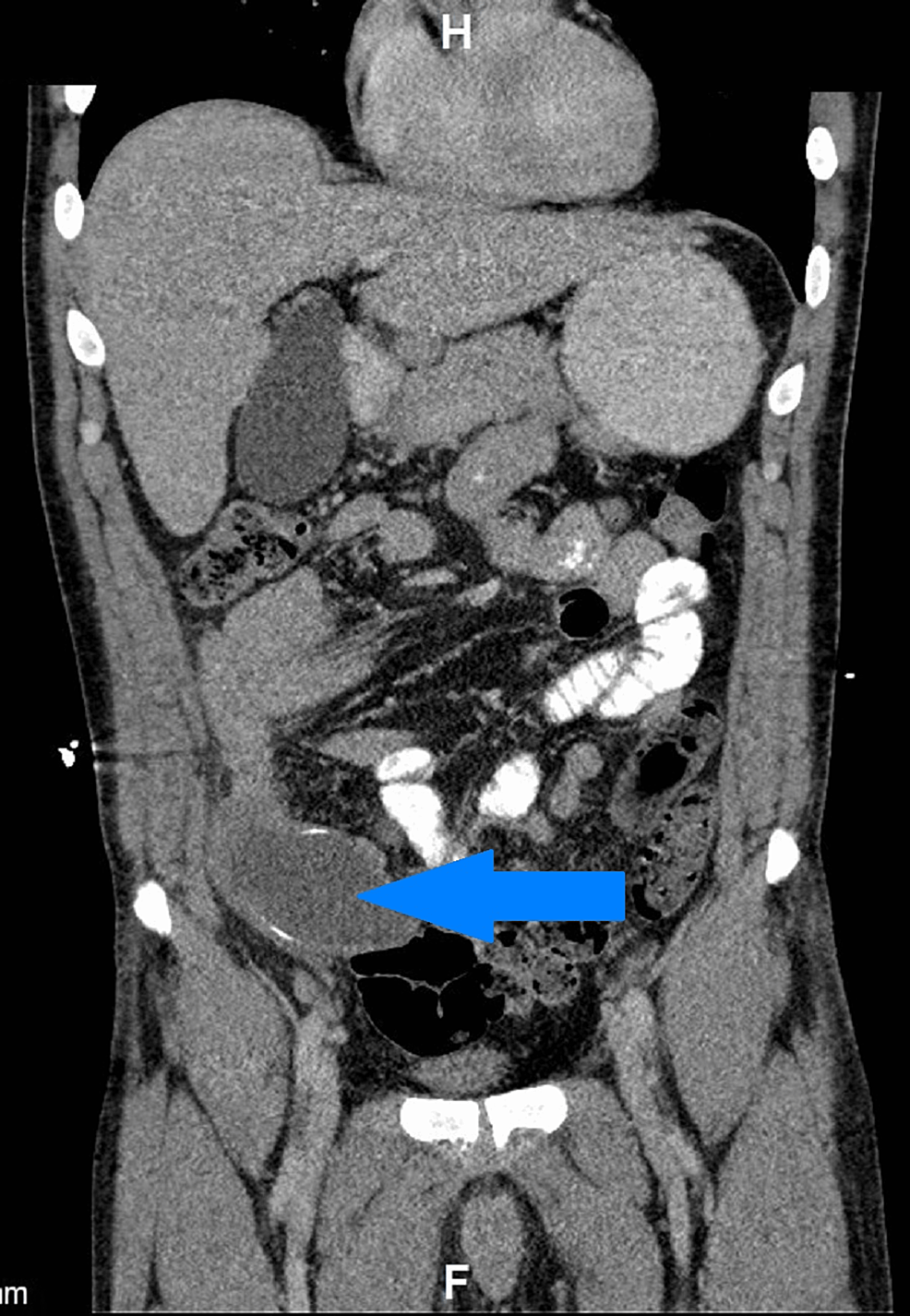 Cureus | Large Mucocele Of The Appendix Discovered In A 48-Year-Old ...