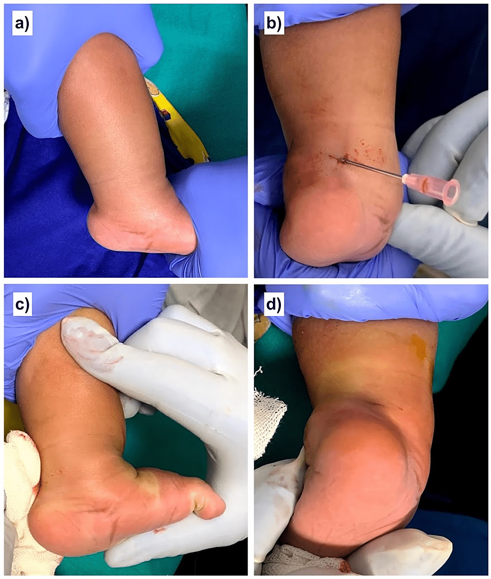 On the cure of club-foot without cutting tendons : and on certain