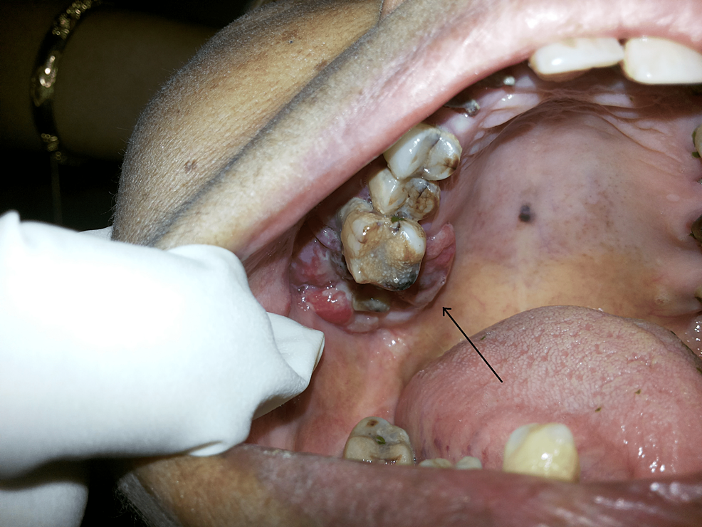Opis przypadku czerniaka złośliwego jamy ustnej: cichy zabójca