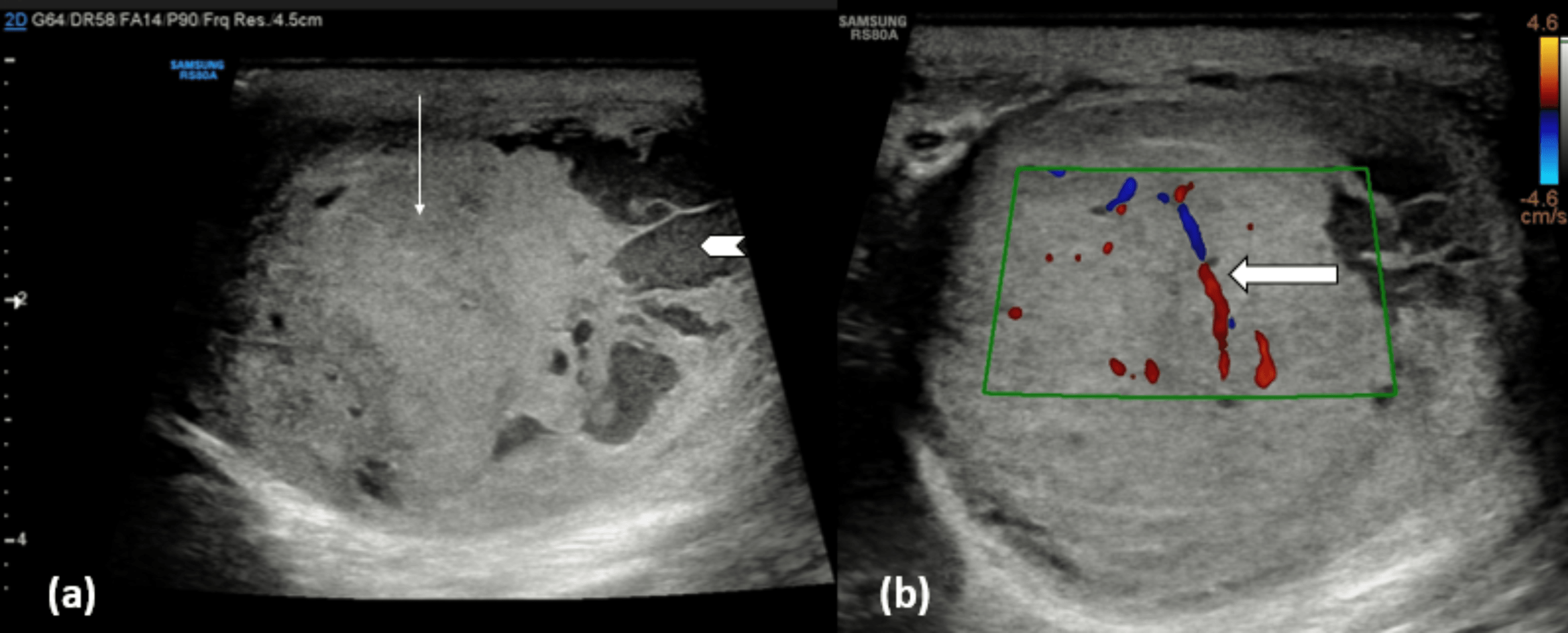 Cureus Diagnostic And Imaging Features Of A Non Seminomatous Germ