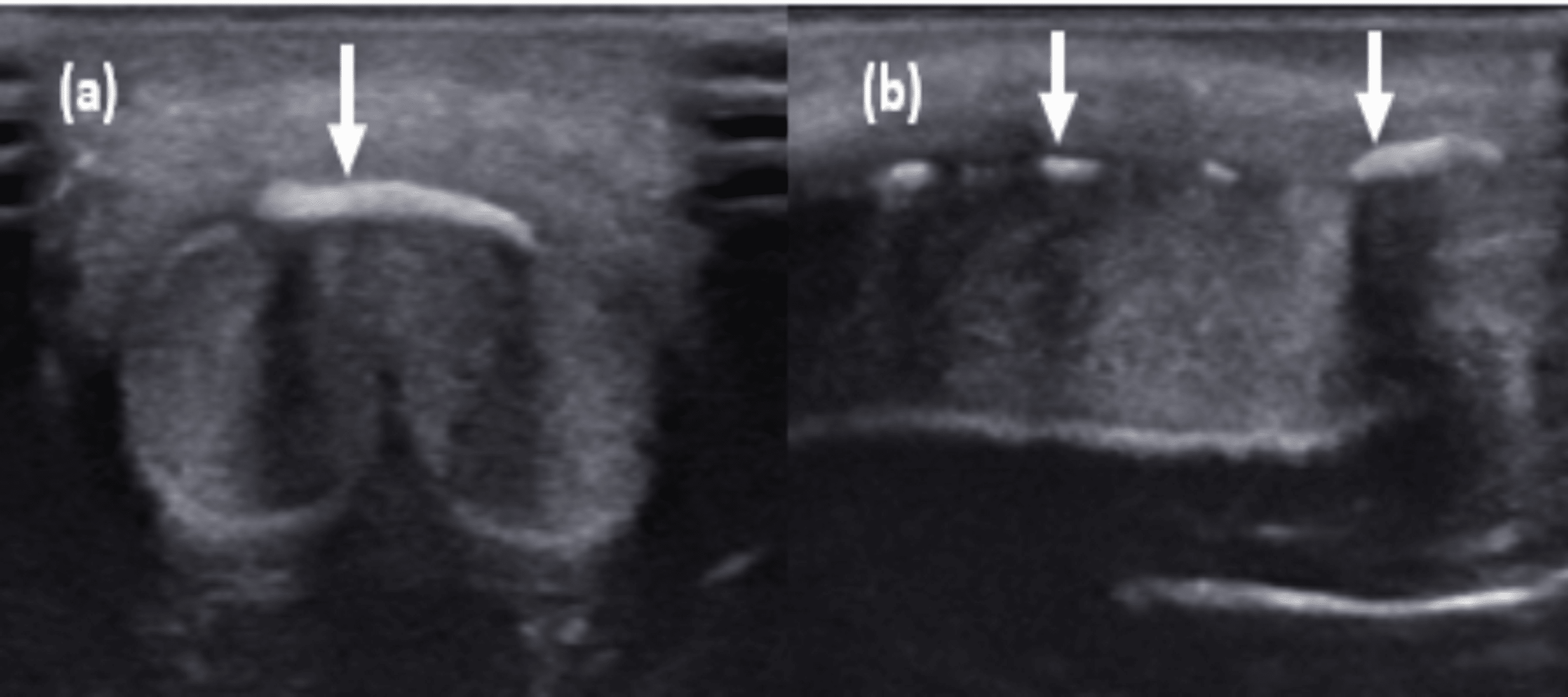 Cureus Peyronie’s Disease Presenting as Curvature of the Penis A