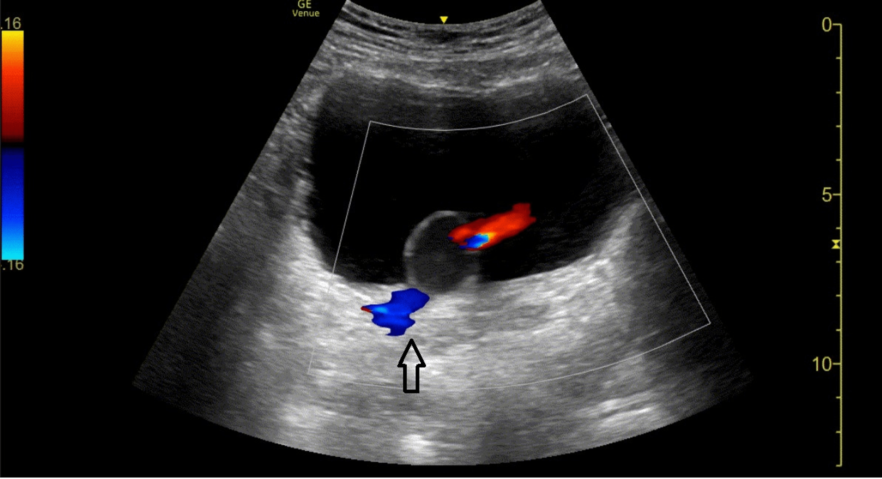 Cureus Ureterocele Diagnosed With PointofCare Ultrasound