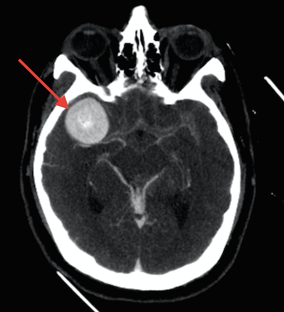 Imaging Evaluation of SAH and Aneurysm