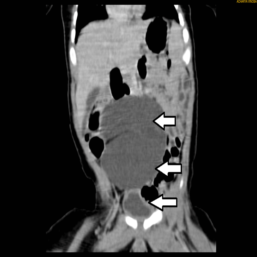 CT-urography-coronal-cut.-From-top-to-bottom,-the-topmost-and-the-middle-arrows-show-a-massively-dilated-renal-pelvis-with-the-ureter-hardly-visualized.-The-arrow-over-the-bottom-shows-the-bladder-in-close-communication-with-the-renal-pelvis.