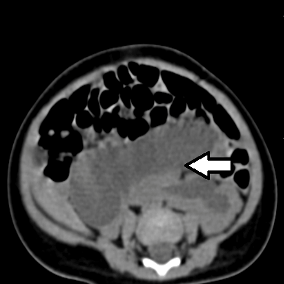 CT-urography-axial-cut-showing-a-horse-shoe-shaped-kidney-occupying-the-retroperitoneum.