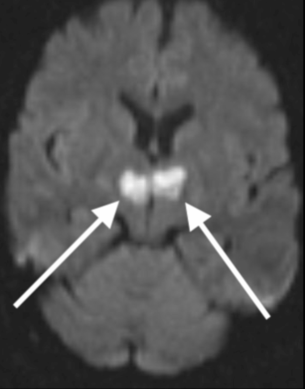 Cureus Blepharospasm and Bradyphrenia With Infarction of the Artery