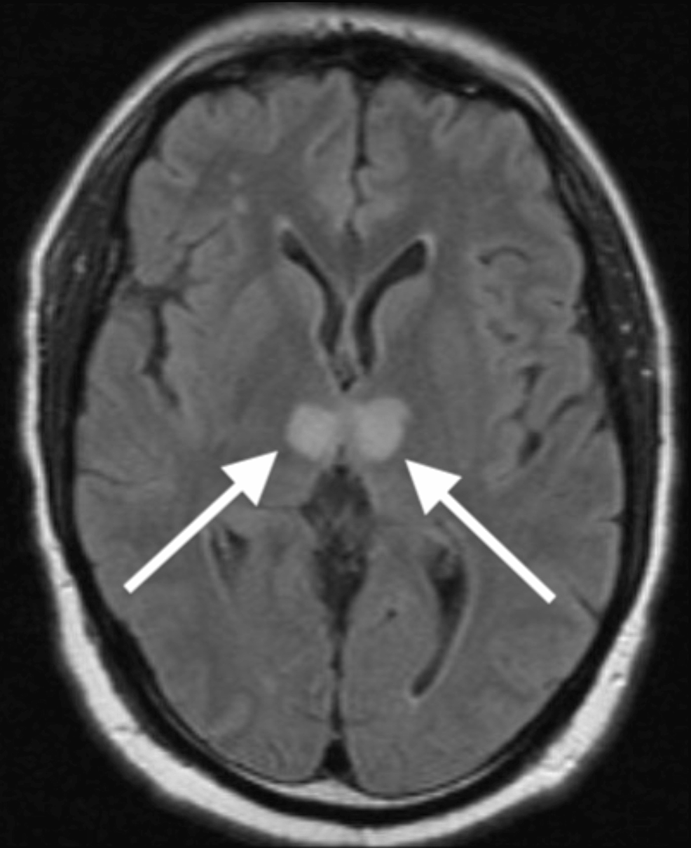 Cureus Blepharospasm and Bradyphrenia With Infarction of the Artery