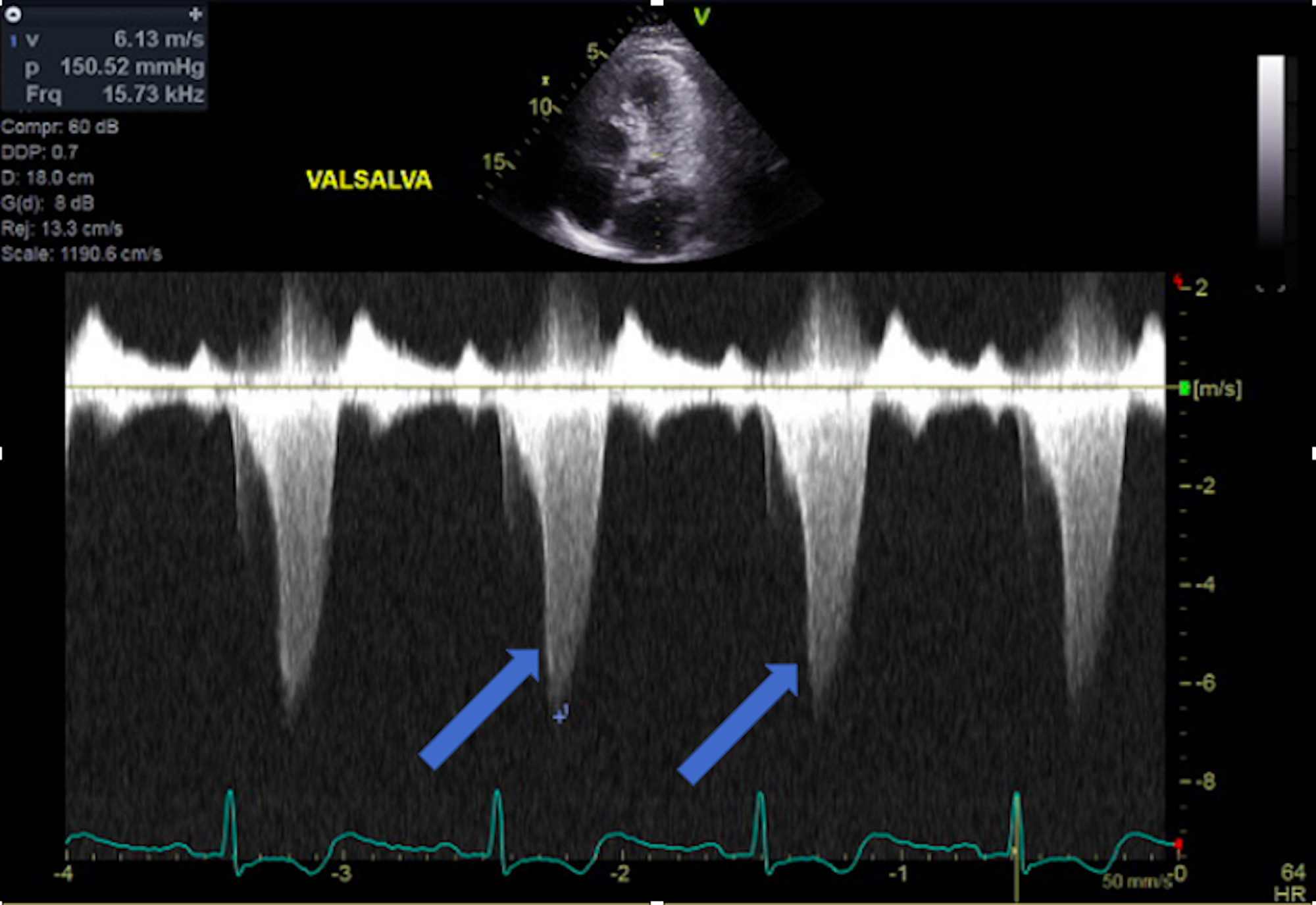 cureus-takotsubo-cardiomyopathy-in-a-patient-with-preexisting