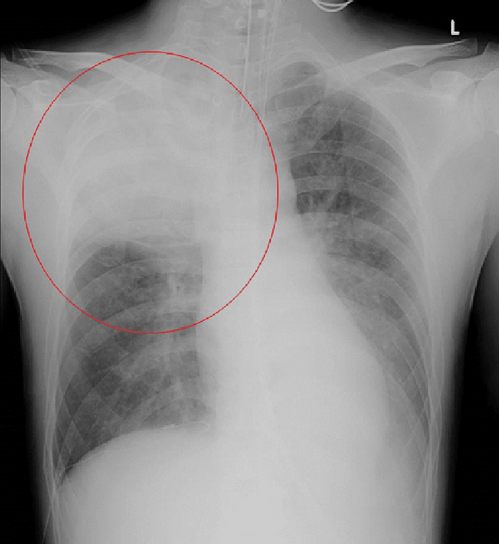 Chest-X-ray-image-at-admission-indicating-a-dense-infiltrative-shadow-in-the-right-upper-lung-field.