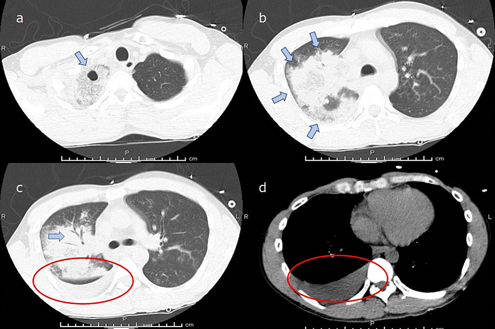 Plain-CT-image-of-the-chest-at-admission.